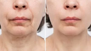 sculptra-antes-e-depois-1300x731