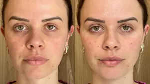 sculptra-antes-e-depois